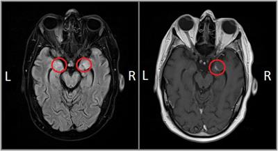 The Role of Amygdala in Self-Conscious Emotions in a Patient With Acquired Bilateral Damage